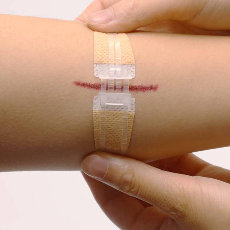 Wound Closures Device - Image 2