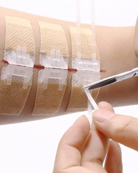 Wound Closures Device
