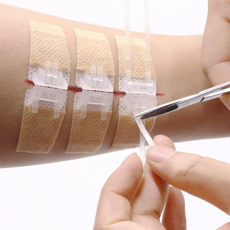 Wound Closures Device